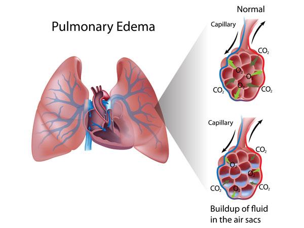 Thumbnail photo for The lungs and Immersion Pulmonary Oedema (IPO) 