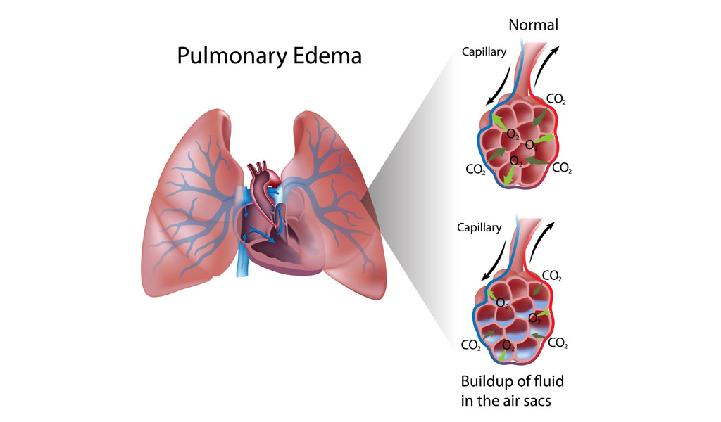 pulmonary edema diagram